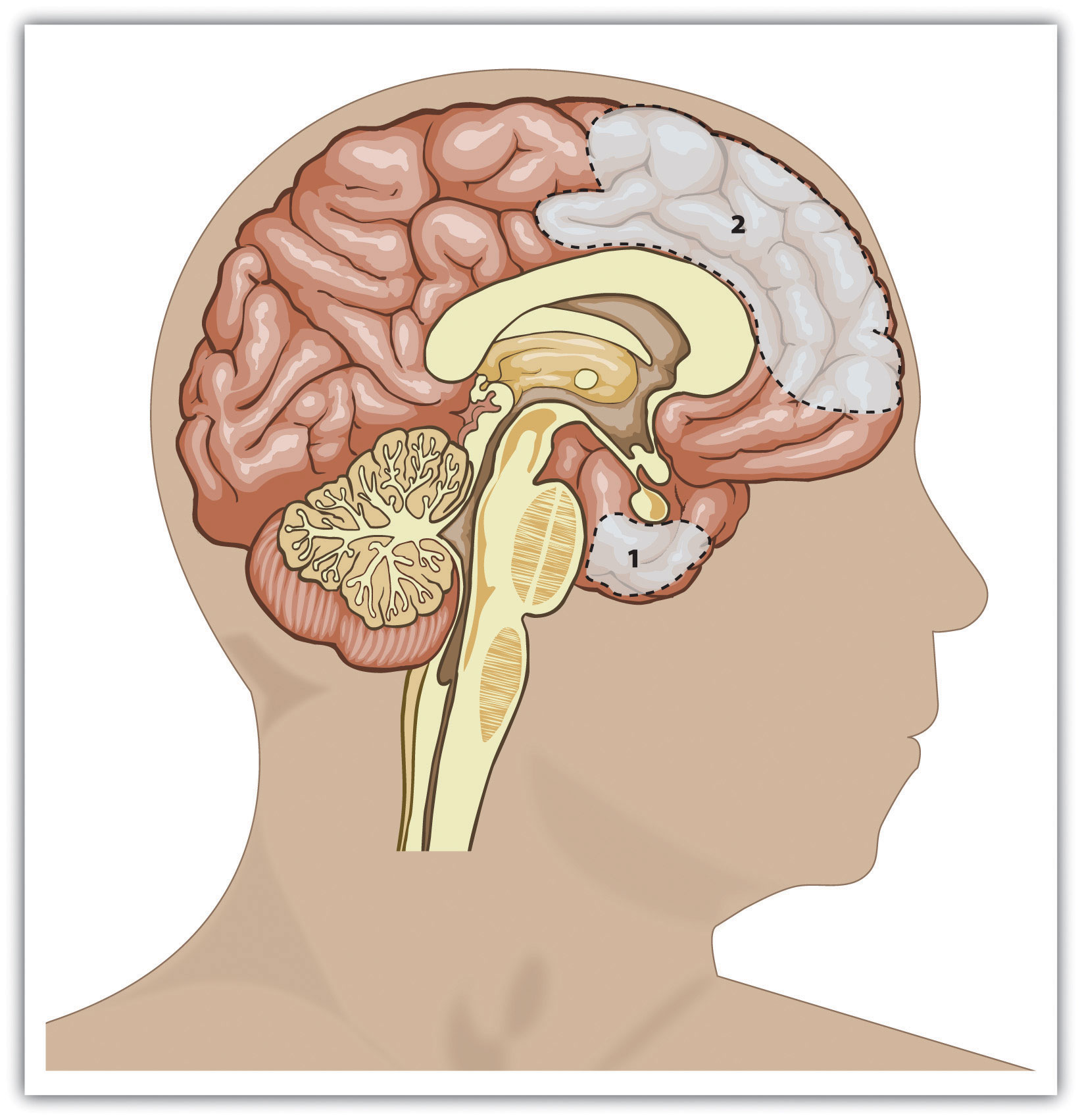 Brain regions that influence aggression include the amygdala (area 1) and the prefrontal cortex (area 2). Individual differences in one or more of these regions or in the interconnections among them can increase the propensity for impulsive aggression.